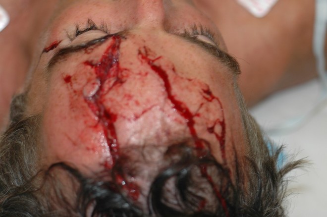 Alt_Nevin head wound 81507.jpg